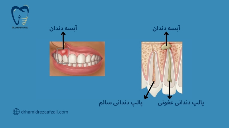 آّسه دندان از سطح دندان و در یک برش طولی نشان داده شده است.