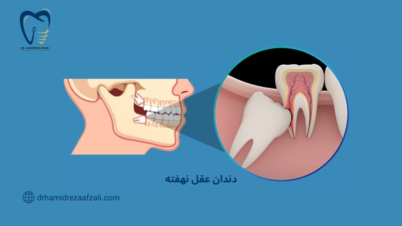 دندان عقل نهفته که دندان جانبی آسیب زده است