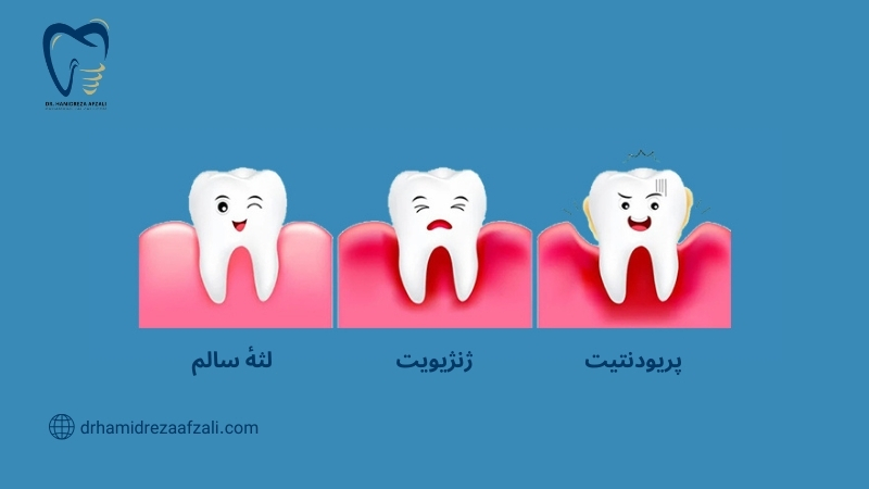 لثه سالم، ژنژیویت و پریودنتیت در دندان نشان داده شده است