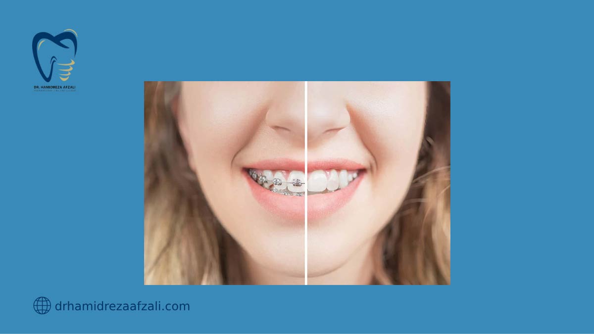 دندان شخصی که با ارتودنسی در حال درمان است