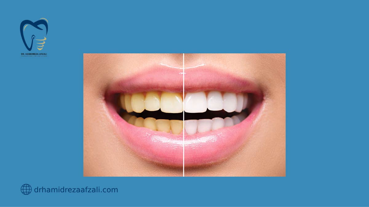 مقایسه دندان زرد و دندانی که با روش زیبایی دندان بلیچینگ سفید شده