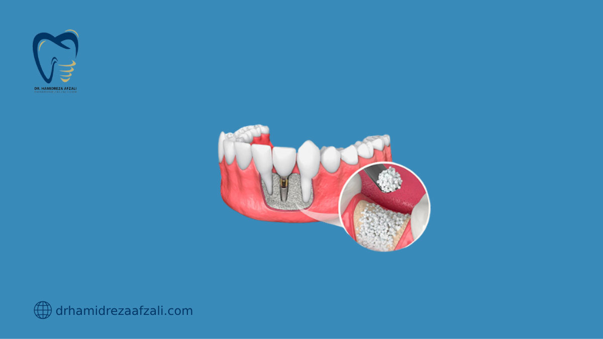 مواد پیوند استخوان در حفره دندان قرار می‌گیرد
