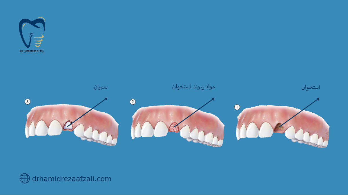 مراحل پیوند استخوان دندان