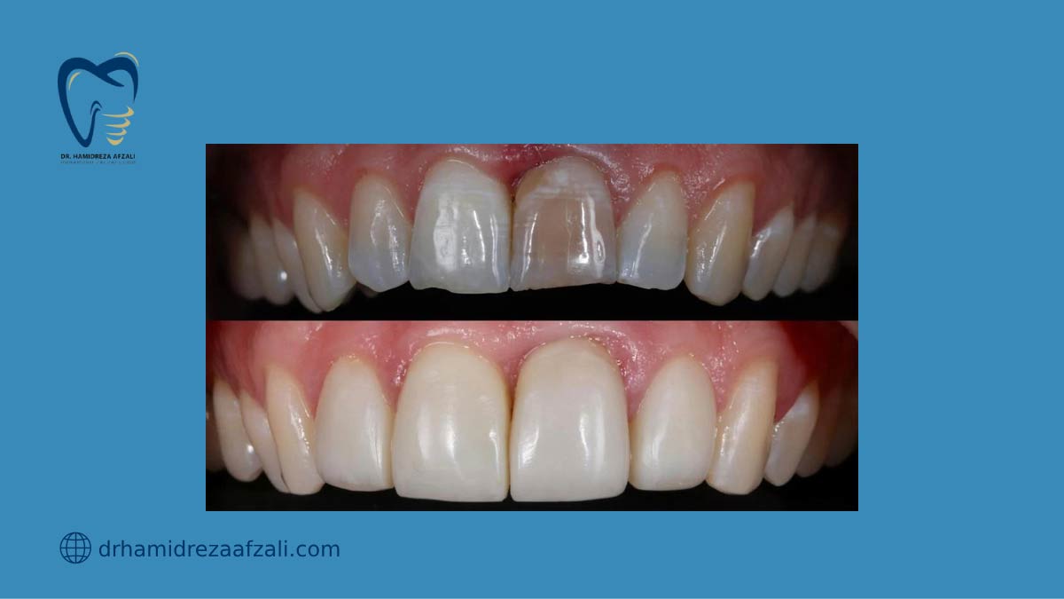 دندان قبل و بعد از انجام کامپوزیت