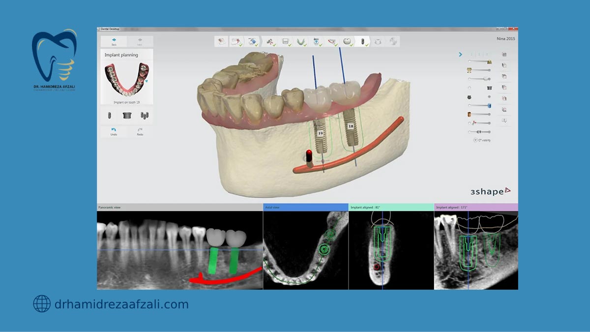 عکس از مراحل انجام ایمپلنت دیجیتال دندان
