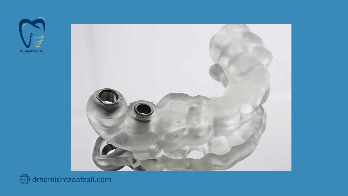 عکس از قالب ایمپلنت دیجیتال دندان