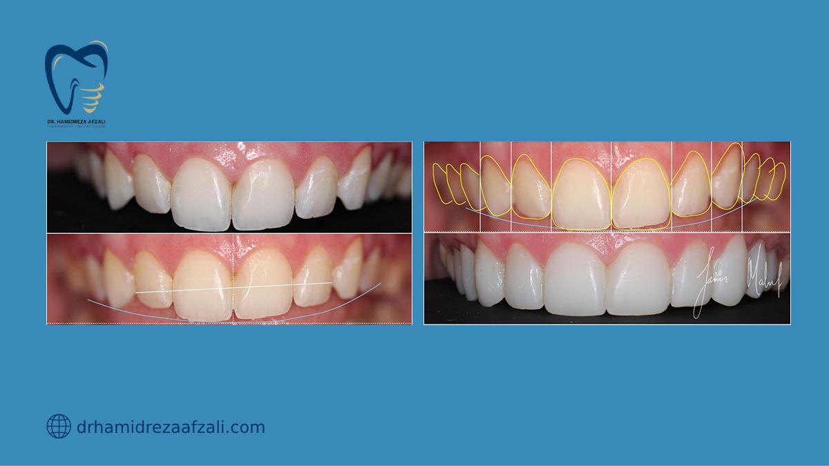 عکس از تغییرات روی دندان با کامپوزیت ونیر