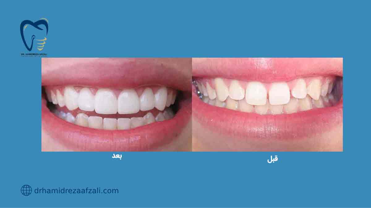 عکس از قبل و بعد لمینت دندان