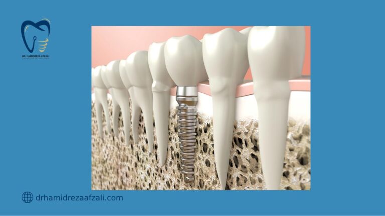 عکس از اینفوگرافی بافت استخوان و ایمپلنت دندان