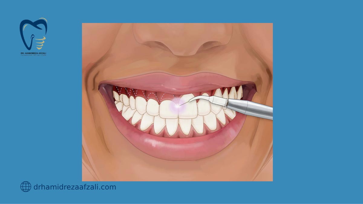 عکس از افزایش طول تاج دندان