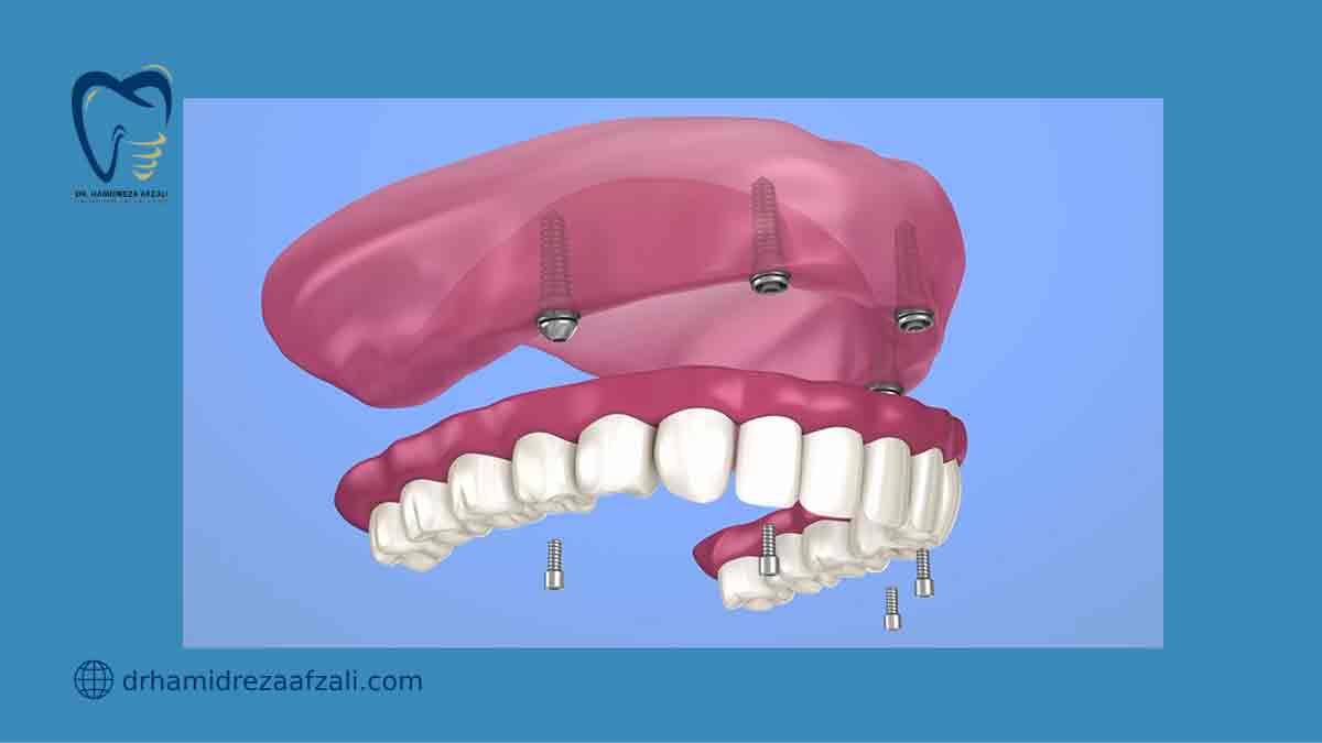 عکس از پروتز اوردنچر دندان