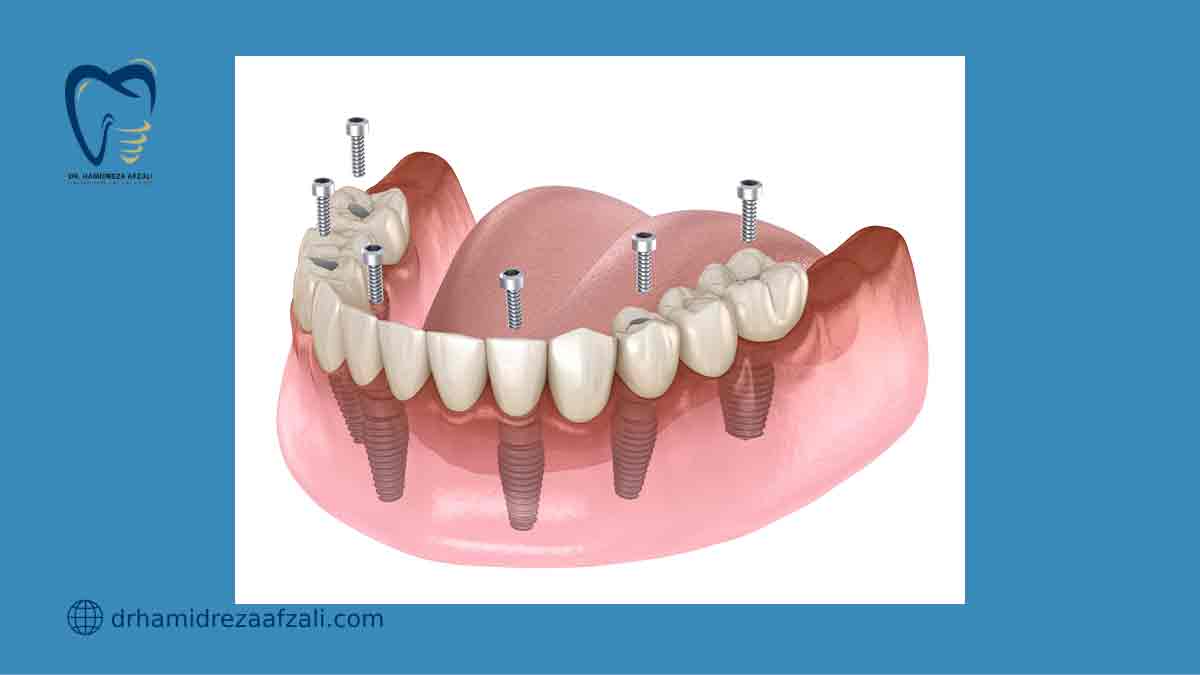 عکس از پروتز دندان ثابت بر پایه ایمپلنت