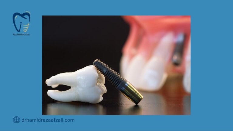 عکس از ماکت ایمپلنت دندان