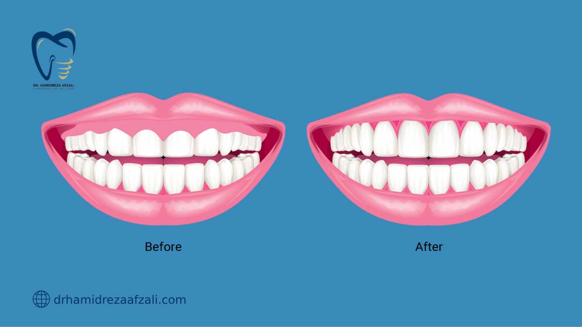 دو دندان در وضعیت قبل و بعد از لیفت لثه.
