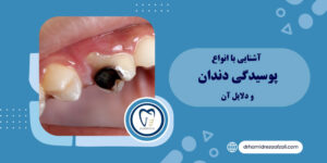 آشنایی با انواع پوسیدگی دندان و دلایل آن