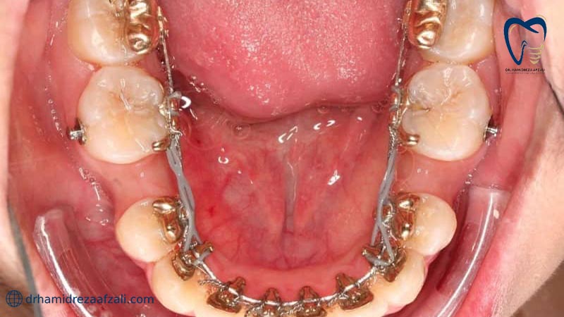 ارتودنسی دندان از داخل دهان