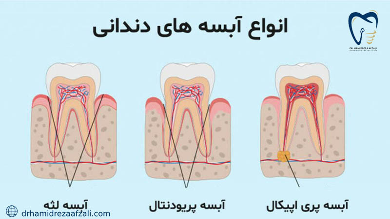 انواع آبسه های دندان