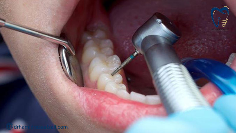 نمایی نزدیک از داخل دندان در حال انجام عصب کشی دندان
