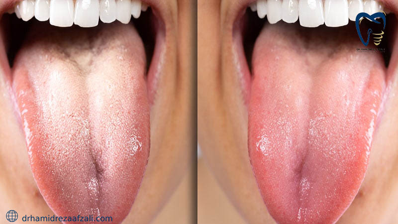 قبل و بعد از برفک زدن دهان
