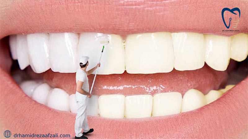 تصویری گرافیکی از رنگ زدن دندان توسط یک مرد
