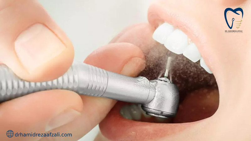 تمیز کردن دندان برای فرآیند پر کردن دندان