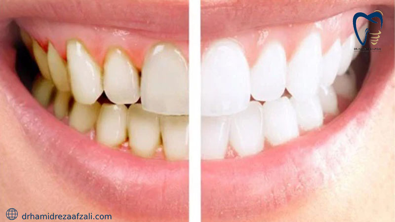 قبل و بعد از جرمگیری دندان از روش های درمان دهان و دندان