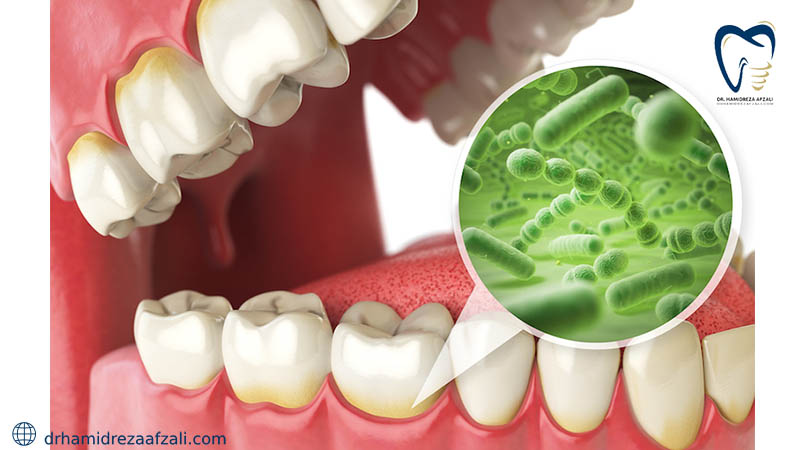 باکتری های مجمود در انتهای دندان