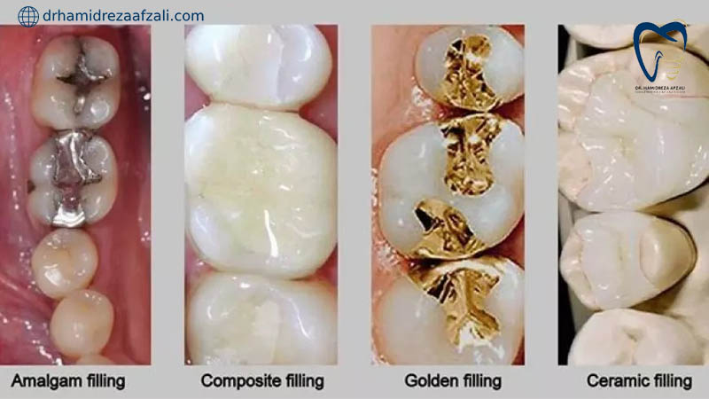پر کردن دندان با 4 مواد کامپوزیت و طلا و آمالگام و سرامیک