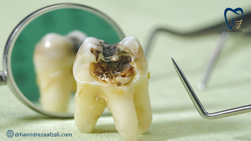 دندان پوسیده و خراب کشیده شده خارج از دهان