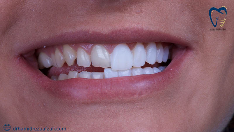 دهان شخصی با نیمی از دندان های معمولی و نیمی از روکش دندان