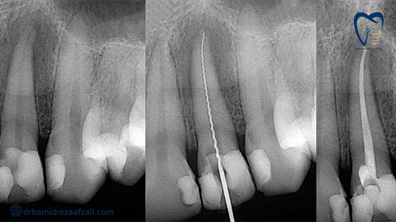 3 تصویر رادیولوژی از ریشه دندان در کنار هم.