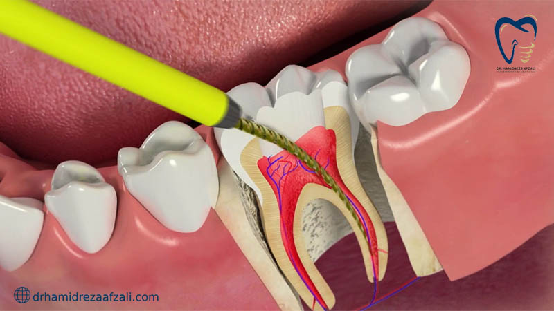 عصب کشی دندان از نمای نزدیک در دهان