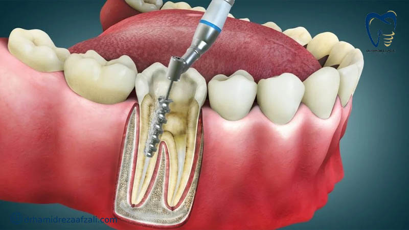 دستگاه دندان پزشکی در حال عصب کشی دندان