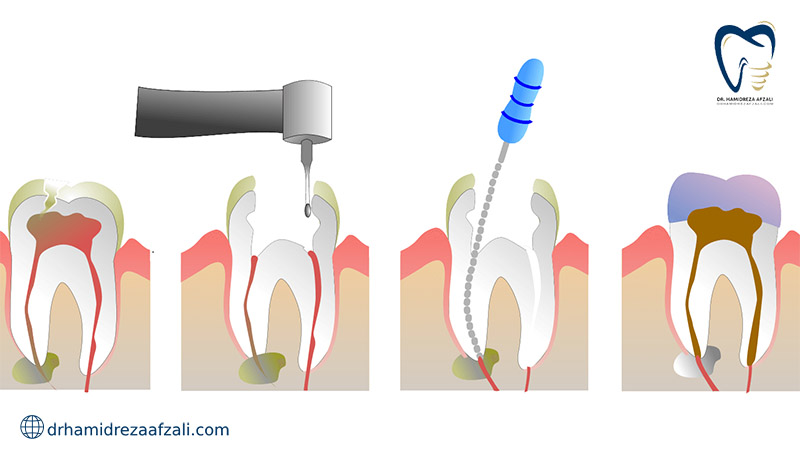 نمایی کارتونی از مراحل انجام عصب کشی دندان خراب