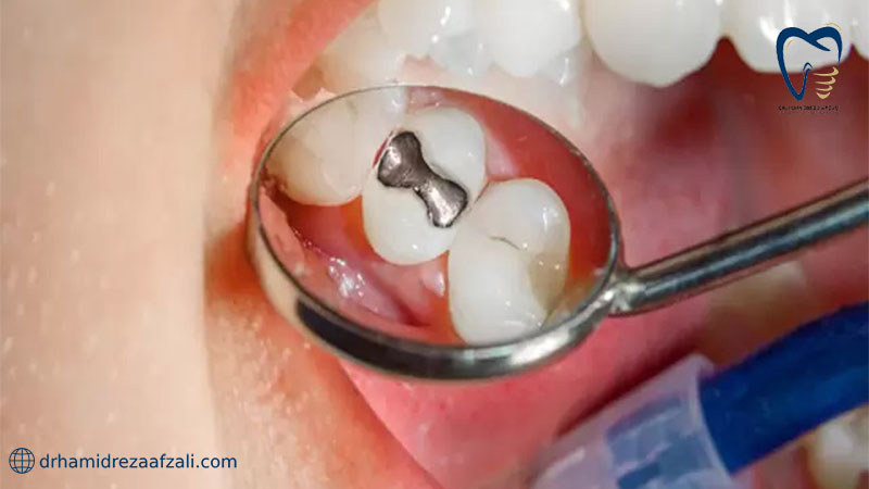 دیدن دندان پر شده در ردیف بالای دهان با آینه مخصوص دندانپزشکی