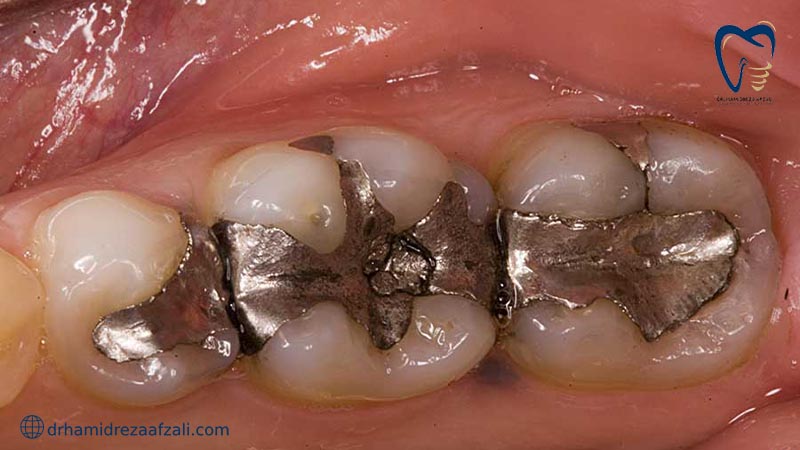 پردن دندان با مواد نقره از نمای نزدیک