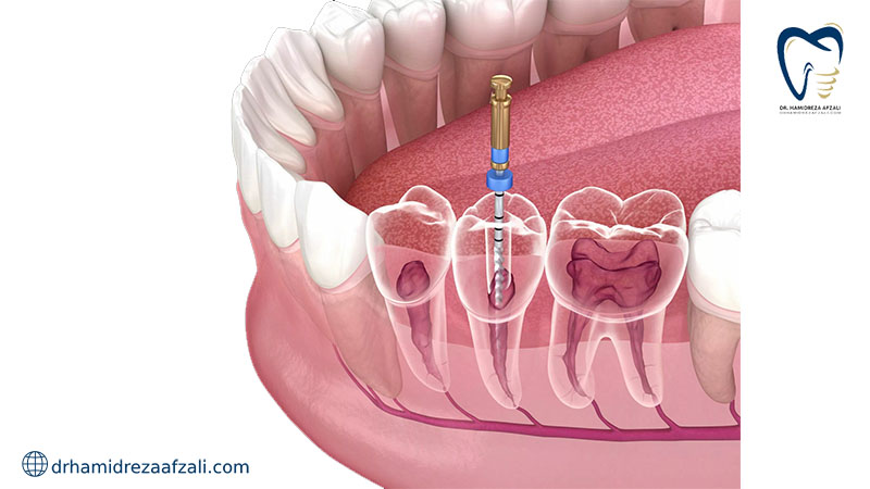 عصب کشی دندان از نمای نزدیک