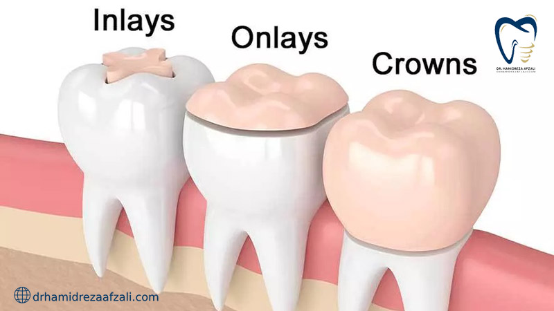 ترمیم دندان با دو روش آنلی و اینلی در کنار روش کرونز