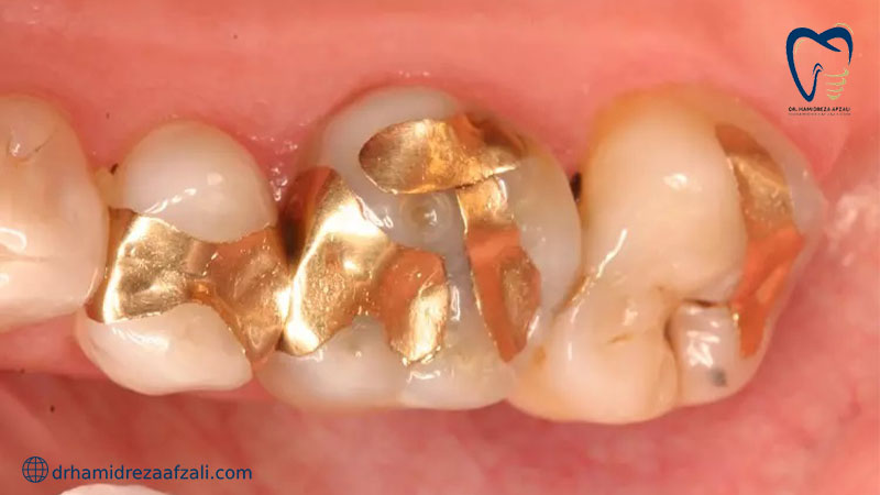 دندان پر شده با مواد طلا 