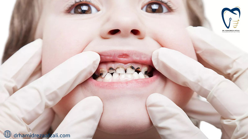کودکی با پوسیدگی دندان متعدد