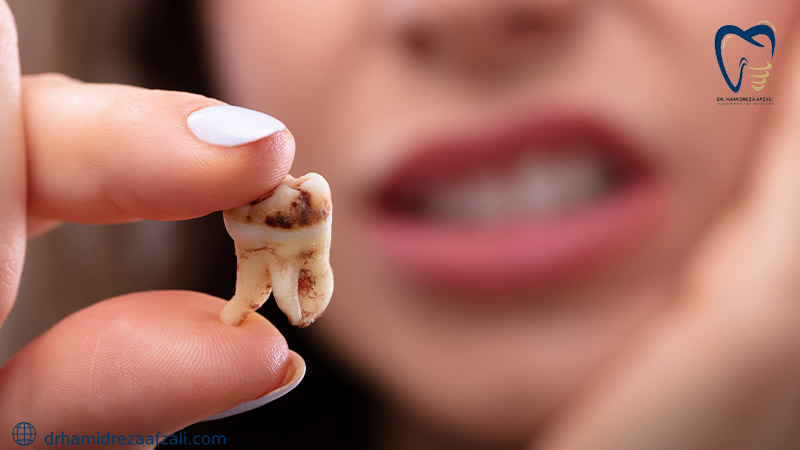 نشان دادن پوسیدگی دندان کشیده شده توسط شخصی
