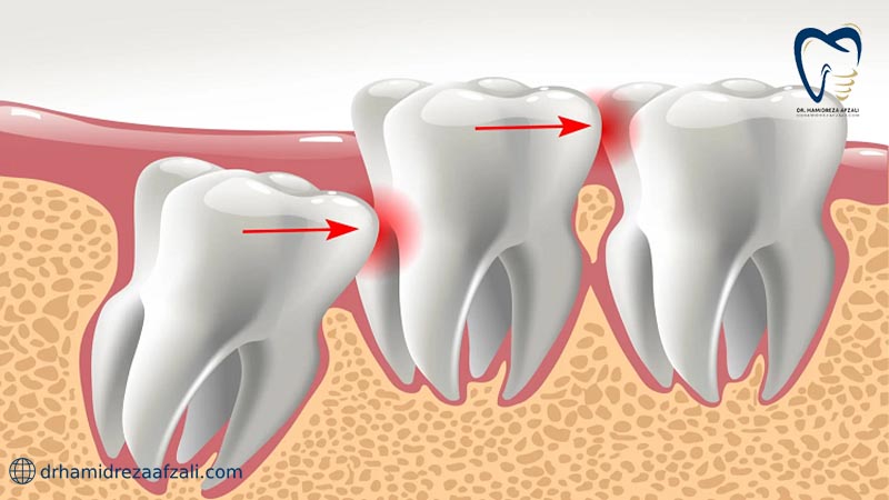 فرآیند کج رشد کردن دندان و آسیب رسانی به دندان های بعدی