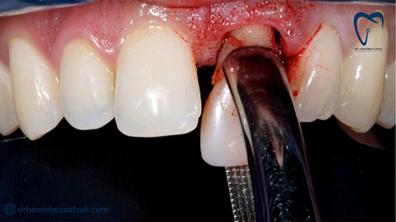 فرآیند کشیدن دندان با ابزار