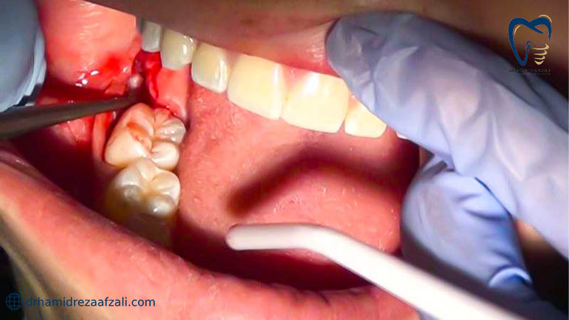 فرآیند جراحی برای دندان کشیدن