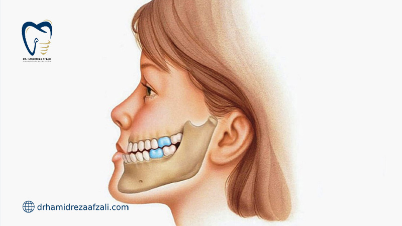 دختری با آندربایت