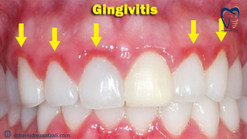 دندان‌های فردی با التهاب لثه