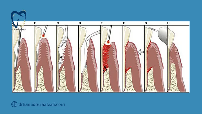 Laser-assisted new attachment procedure