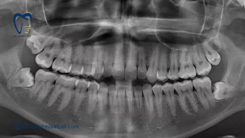 تصویر پانورامیک دندان