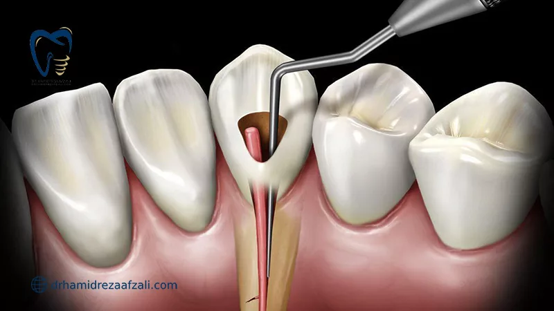 عصب کشی دندان