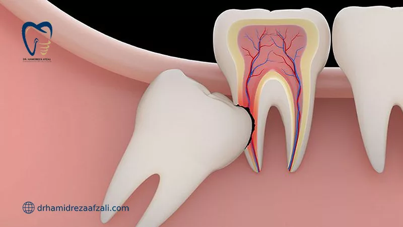 آسیب دیدن دندان مولر دوم به دلیل نهفته بودن دندان عقل.
